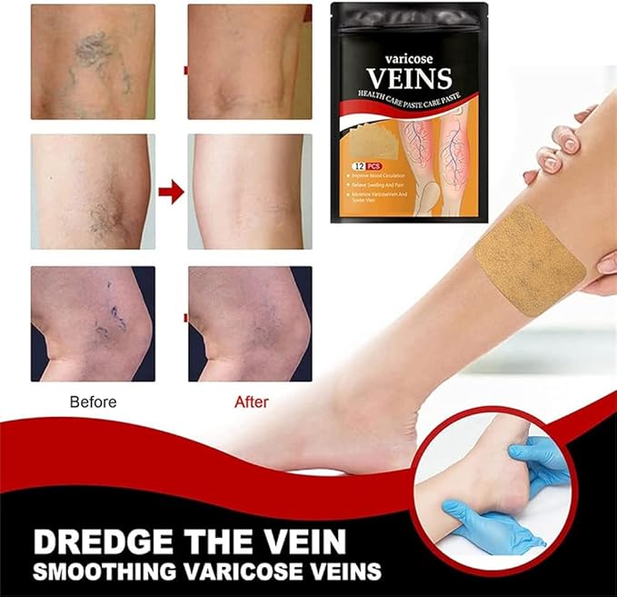 BORRA TUS VARICES | RESULTADOS RÁPIDOS Y EFICACES