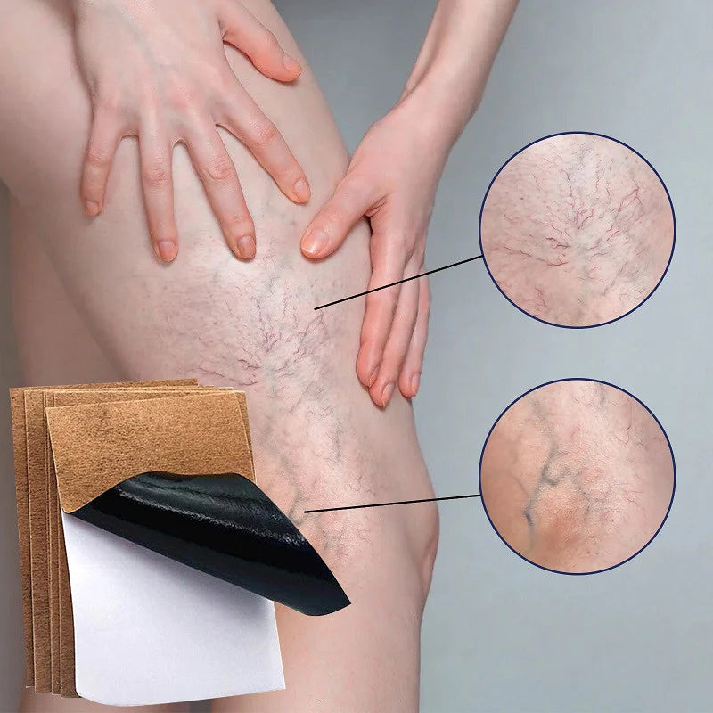 BORRA TUS VARICES | RESULTADOS RÁPIDOS Y EFICACES